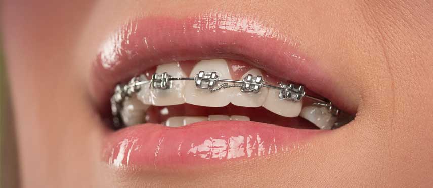 Brackets o Frenos Dentales