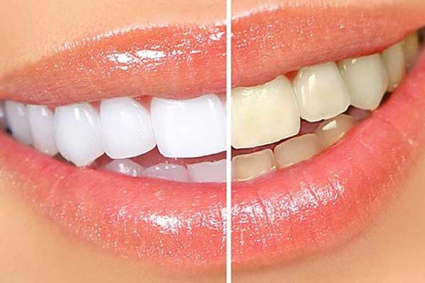 Blanqueamiento de dientes