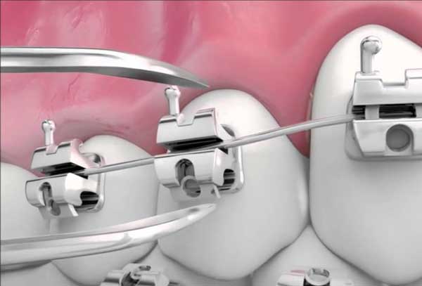 Brackets autoalineado