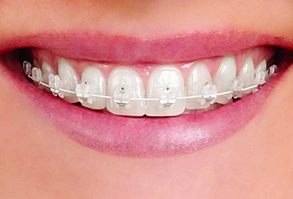 Brackets estéticos o invisibles