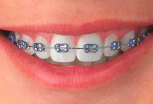 Brackets metálicos