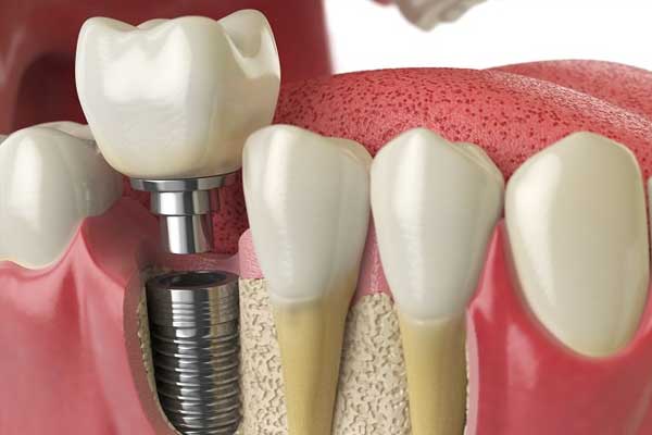 Implantología - Implantes de dientes