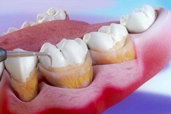 Periodoncia Tratamiento Dental